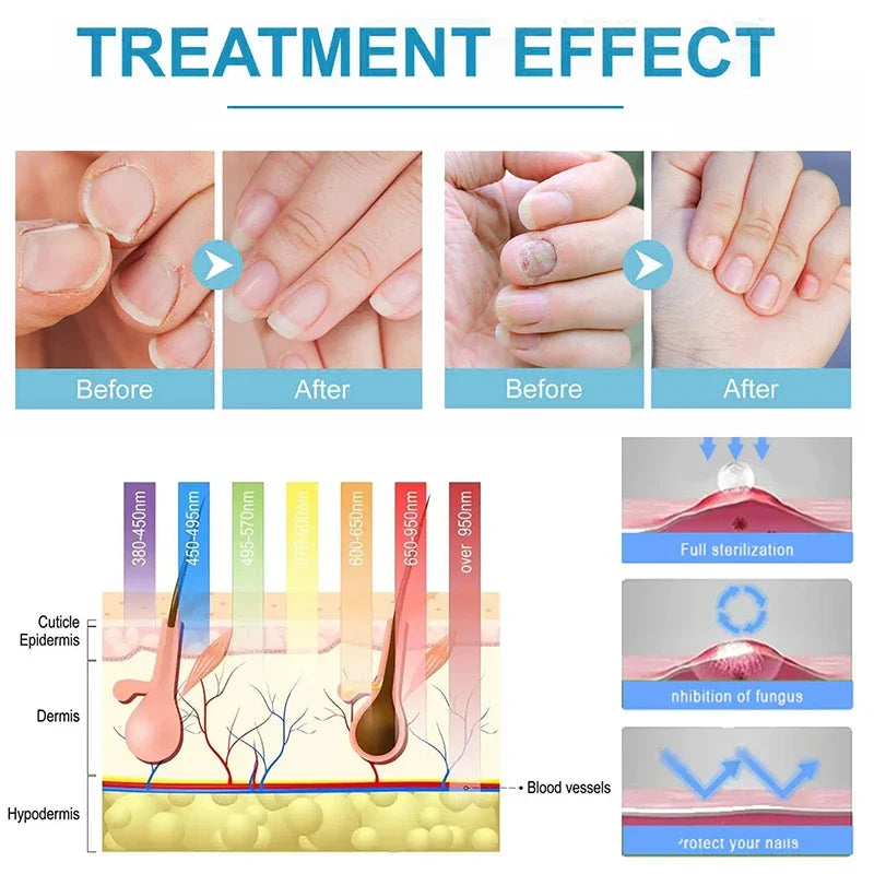 Laser Nail Fungus Treatment Device - Footcare