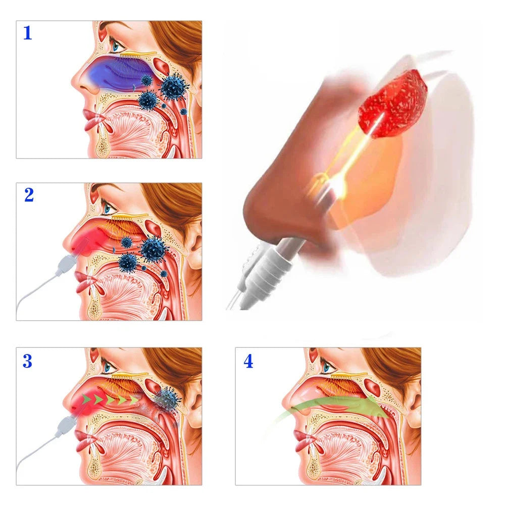 BioNase Rhinitis Therapeutic Instrument