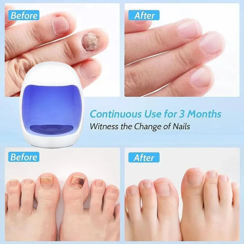 Laser Nail Fungus Treatment Device - Footcare